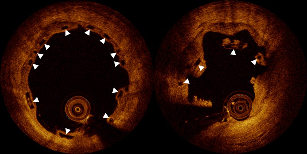 Bio-Stent